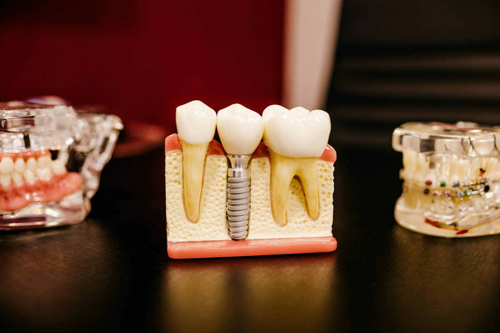 Modelo de implante dentário